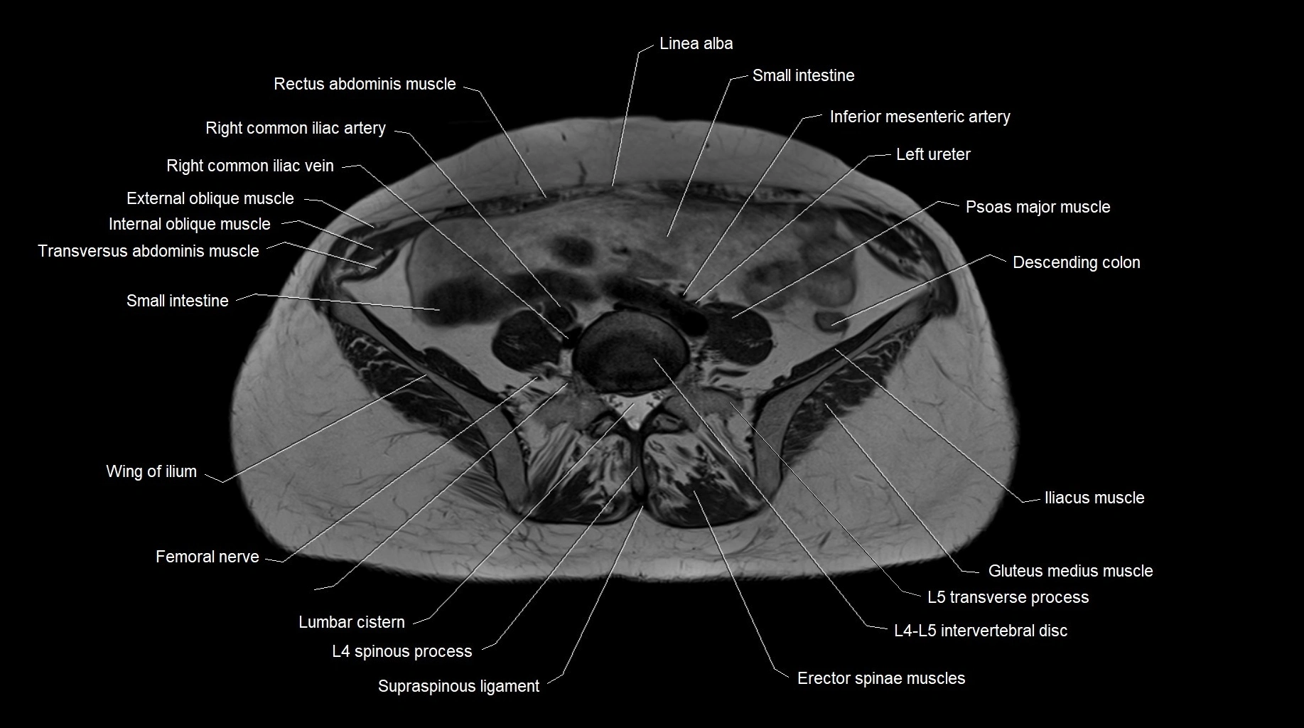 MRI 3T pelvis axial cross section anatomy image 4.webp